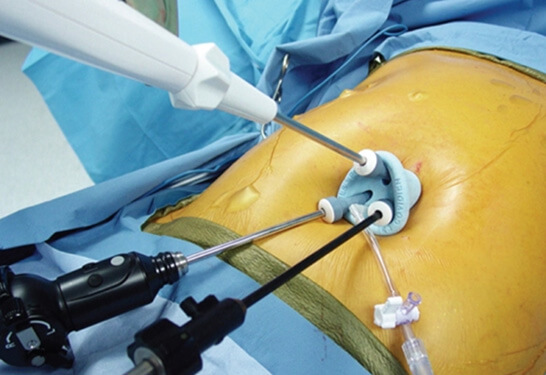 Magenoperation in der Türkei mit Single Incision Laparoscopic Surgery