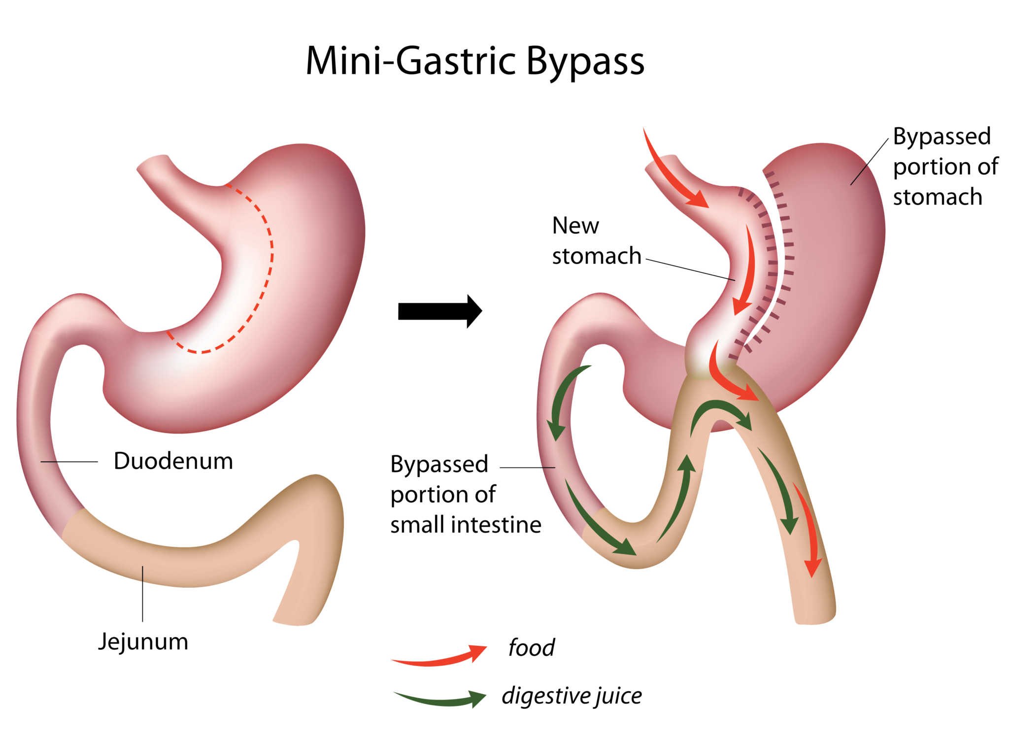 Omega Loop-Magenbypass vs. Roux-Y-Magenbypass: Was ist besser?