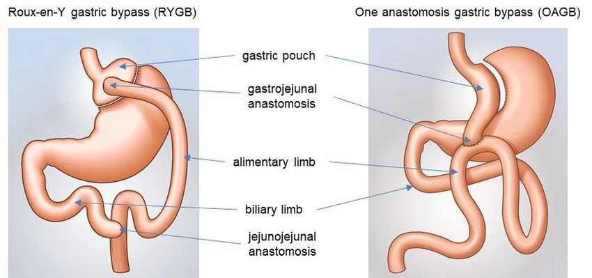 Omega Loop-Magenbypass vs. Roux-Y-Magenbypass