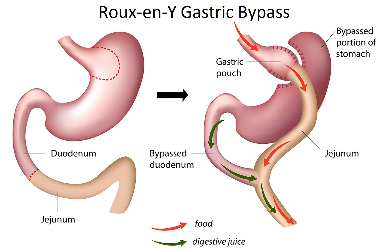 Omega Loop-Magenbypass vs. Roux-Y-Magenbypass: Was ist besser?