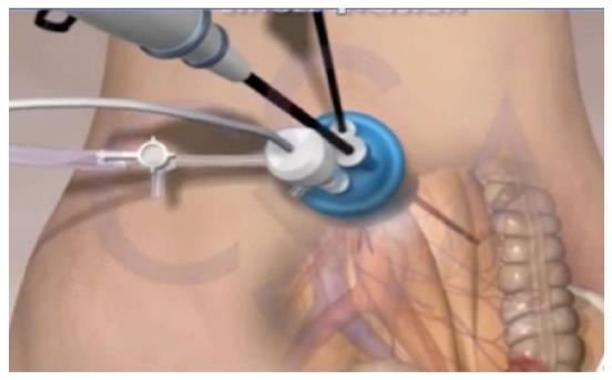 Single Incision Laparoscopic Surgery Türkei Antalya SILS-S Schlauchmagen ohne narbe