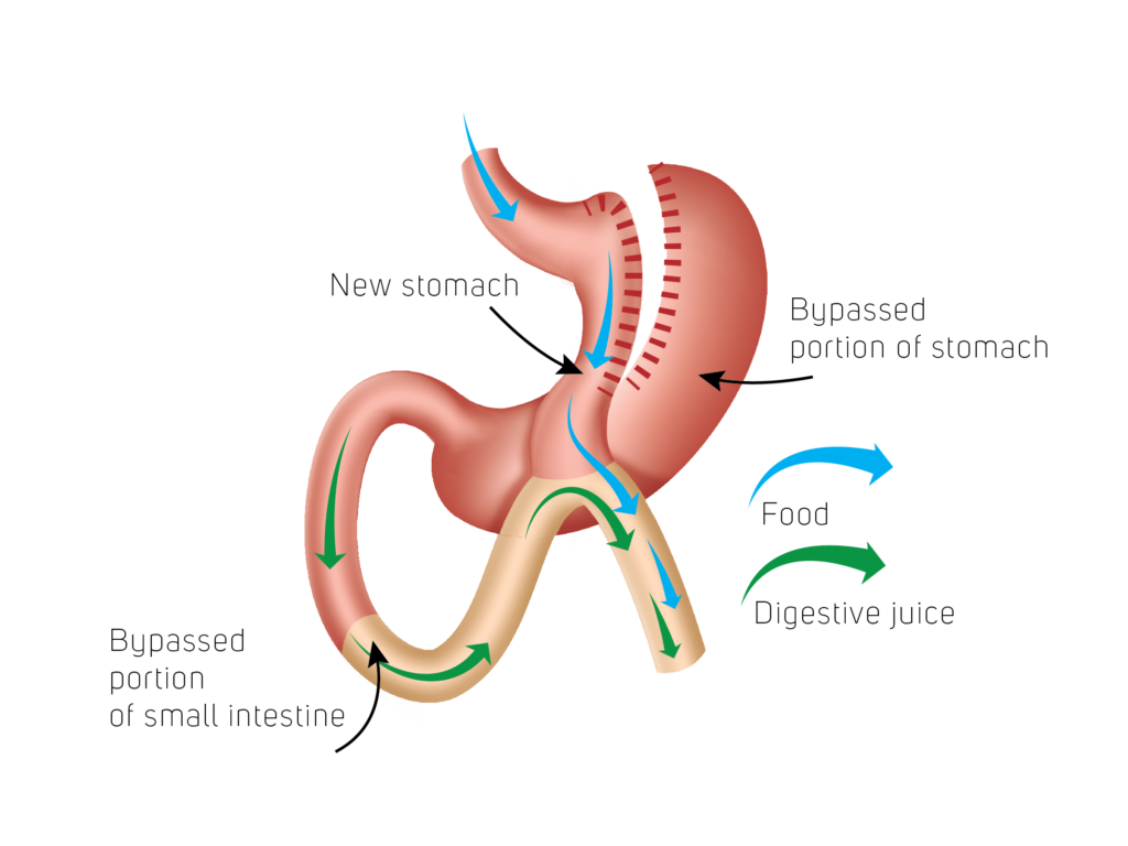 5 Schritte zur Vorbereitung auf deine Gastric Sleeve OP 7 Vorbereitung auf deine Gastric Sleeve OP Erstelle ein bild