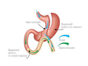 Vorbereitung auf deine Gastric Sleeve OP Erstelle ein bild