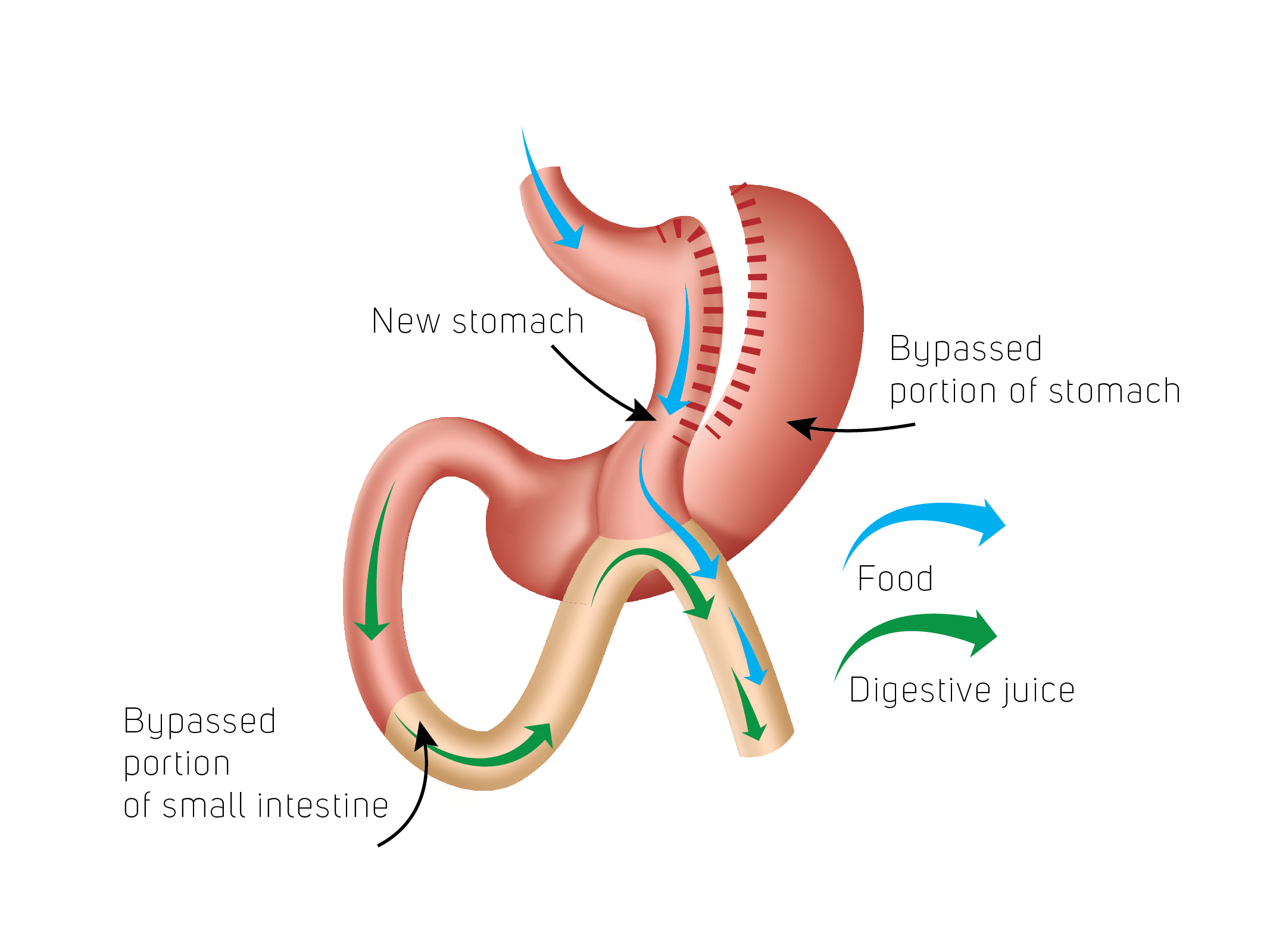 Vorbereitung auf deine Gastric Sleeve OP Erstelle ein bild